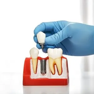 dental-implant